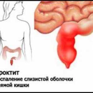 Ce este proctita intestinului?