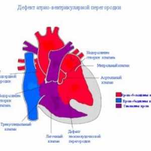 Defect septal ventricular al inimii: cauzele, tratamentul, simptome, semne