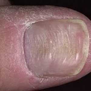 Deformarea unghiilor: cauze, tratament