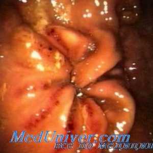 Disfuncții ale sistemului hipofizo-suprarenale in boala ulcer peptic