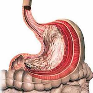 Tumoră benignă gastric
