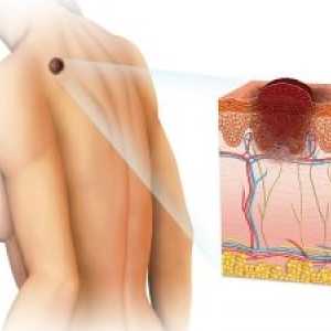 Tumorile benigne ale pielii: tipuri, clasificare, tratament, simptome