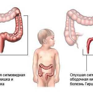 Dolichosigma intestinale la copii