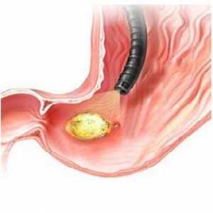 EGD în diagnosticul de gastrită erozivă