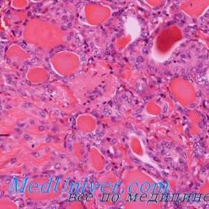 Folicular adenocarcinom cu celule mari și tiroidiene alveolară
