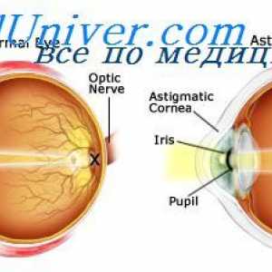 Lentile de contact. Viziune cu cataractă