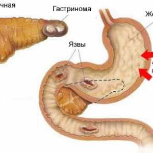 Gastrinom pancreasului