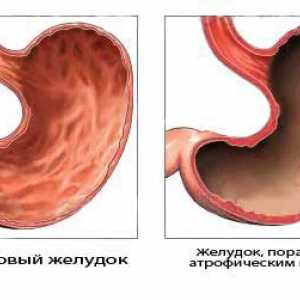 Gastrita și cancerul gastric