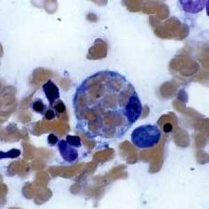 Lymphohistiocytosis hematofagic: tratament, cauze, prognosticul