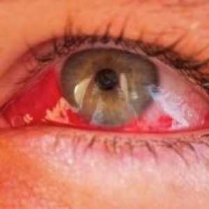 Hemoftalm tratament ochi, cauze, simptome de clasificare,