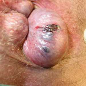 Hemoroizilor și infecții, tratamentul bolilor infecțioase