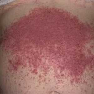 Dermatita herpetiforma: simptome, tratament