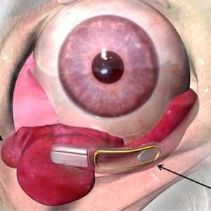 Implant oculara pentru tratamentul xeroftalmie
