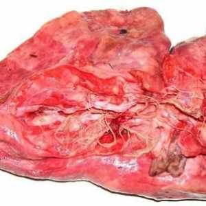 Worms (viermi intestinali) in plamani la om simptome și tratament