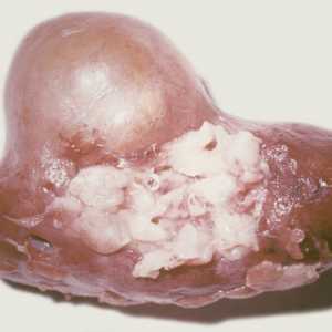 Viermi în rinichi uman, simptomele de viermi în ele