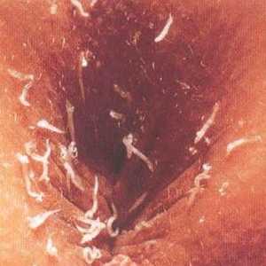 Worms în organele de reproducere în vagin, uter, buze