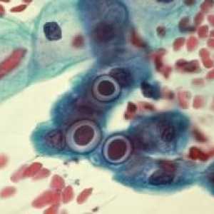 Infecția cu chlamydia: tratament, simptome, semne, diagnostic, cauze