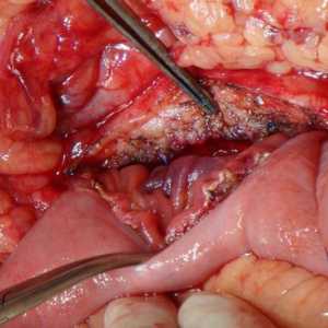 Indurativny Pancreatita cronică
