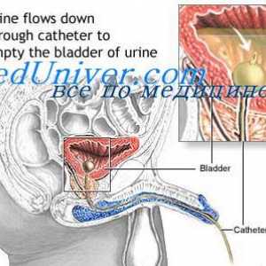 Atonia vezicii urinare. vezicii urinare involuntara
