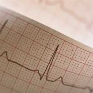 Instabilitatea miocardic electric: tratament, cauze, simptome, semne