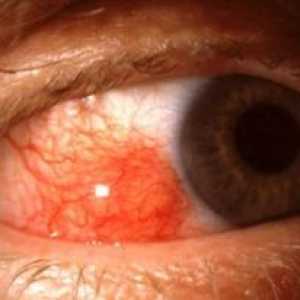 Episcleritis ochi: tratament, simptome, cauze