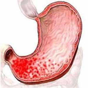 Eroziv catarală cronică focală gastrită superficială