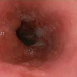 Esofagita de reflux eroziva si gastrita