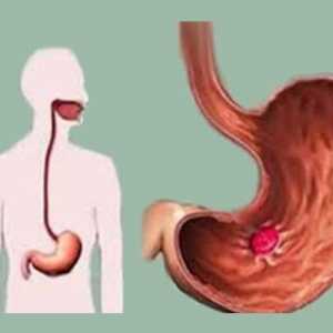 Etiologia si patogeneza ulcerului gastric
