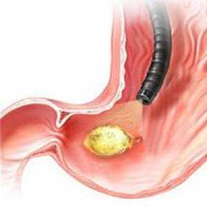 Cum de a evita repetarea bolii de ulcer peptic? Prevenirea ulcerului duodenal