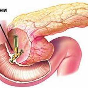 Pietrele (calculi) in pancreas si simptomele de tratament (chirurgie, îndepărtarea)
