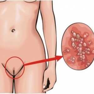 Candida vaginita: tratament, simptome, cauze, simptome