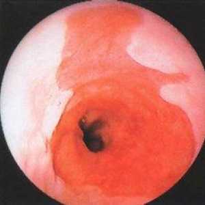 Catarală (suprafață) esofagitei treime inferioara a esofagului