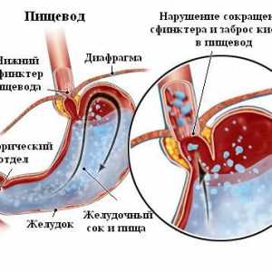 Clasificarea esofagita