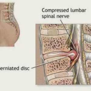 Compresia măduvei spinării (sindrom): simptome, tratament