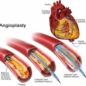 Angioplastie coronariană