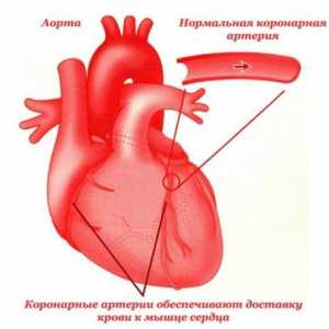 Tromboză coronariană