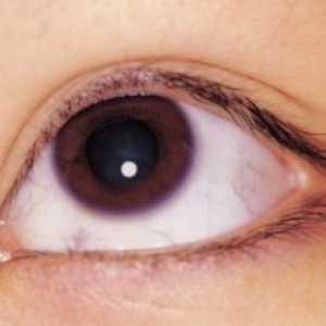 Ochi cheratită limită: tratament, cauze, simptome