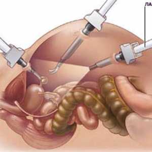 Pancreas laparoscopie în pancreatita