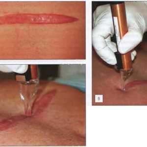 Laseri în tratamentul cicatricelor. Metode de tratament