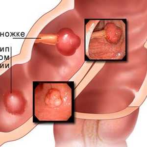 Tratamentul de polipi in stomac
