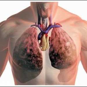Supurație pulmonară