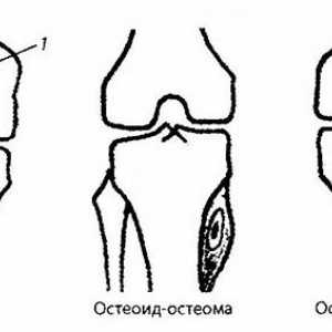 Radiații si diagnostic instrumental al genunchiului patologiei articulare. Tumora a articulației…
