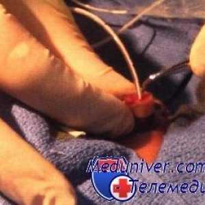 Metode de colectare de sânge de cateter arterei ombilicale