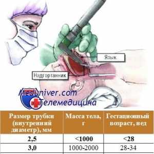 Dificultăți intubare traheală la sugari