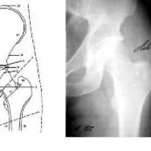 Metodele de diagnosticare cu raze X: raze X a articulației șoldului