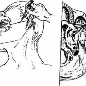 Metodele analgezie mandibular