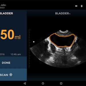 Scaner cu ultrasunete miniatură pentru urologi