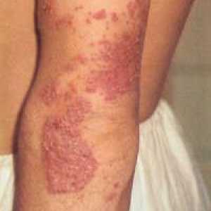 Miniatlas: boli ale pielii însoțite de mâncărime