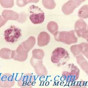 Lipsa mieloperoxidazei (MPO). Clinica și diagnosticare