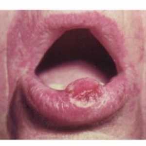 Neoplasmul în cavitatea orală la om